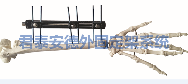 上肢延长/搬移架外固定支架
